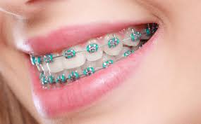 Teeth Braces