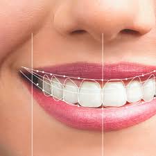 Smile Designing