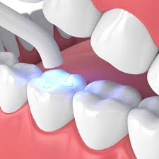 Teeth Fillings