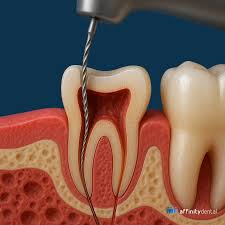 RootCanal Treatment